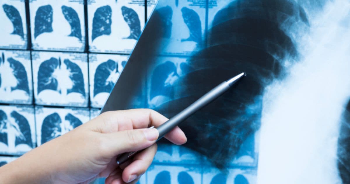 Polarean inks US sales deal to boost lung imaging product reach